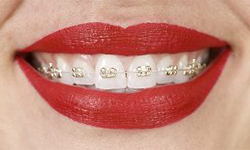 inconix braces